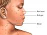 Chickenpox