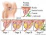 Carcinoma of Prostate