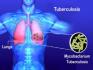 Tuberculosis (TB)