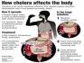 Cholera
