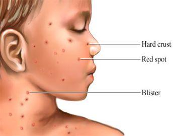 Chickenpox
