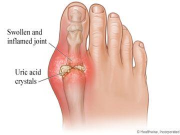 Gout