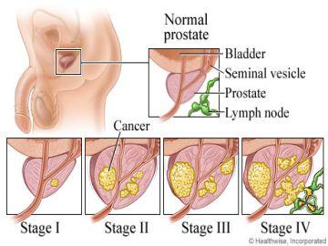 Carcinoma of Prostate