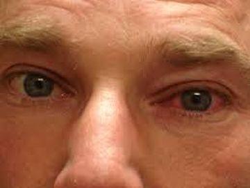 Conjunctivitis