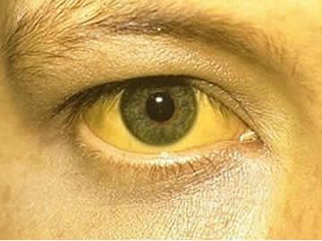 Jaundice