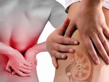 Kidney stone