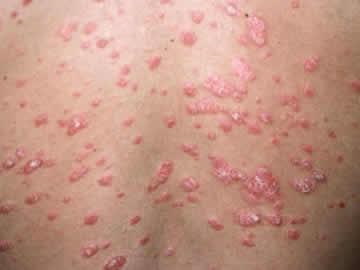 Psoriasis