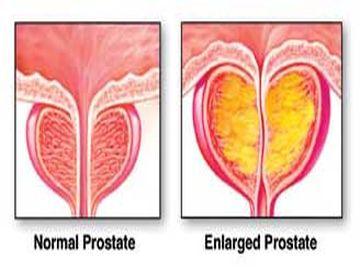 Enlarge Prostate