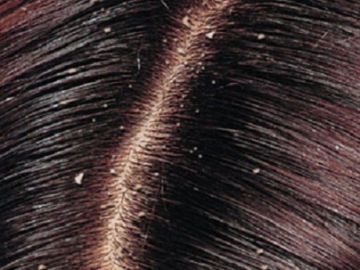Dandruff