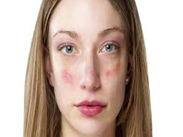 Skin Diseases