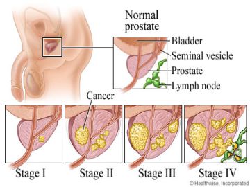 Carcinoma of Prostate