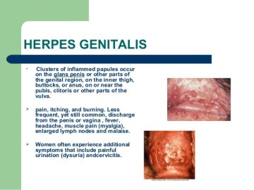Genital Herpes Also called: Herpes genitalis