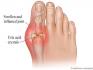 Gout