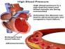 High Blood Pressure (Hypertension)